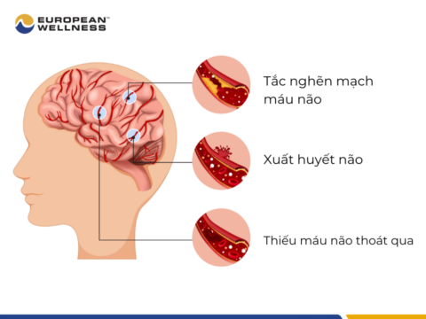 Đột quỵ là gì?