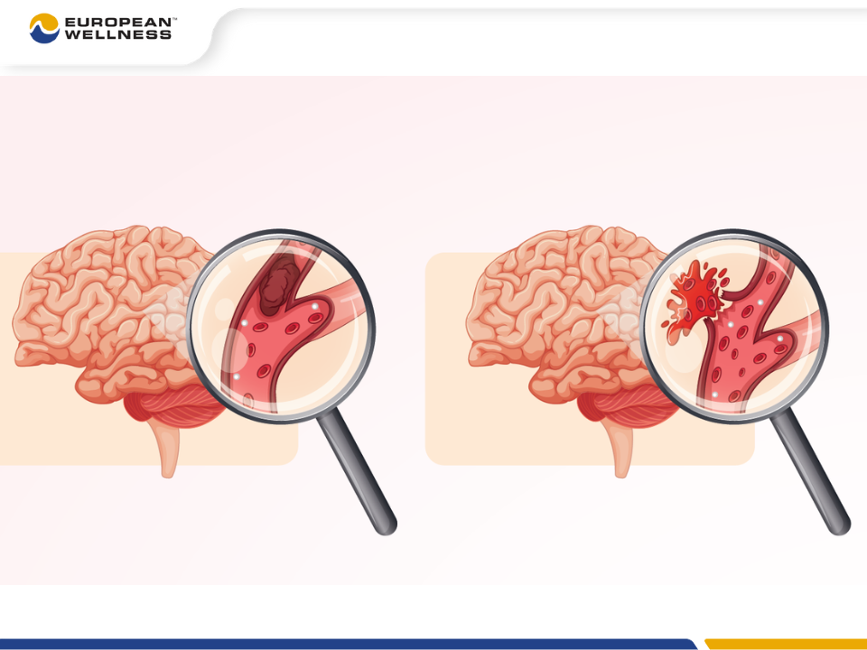 Tai biến mạch máu não là gì?