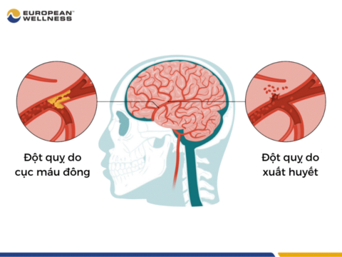 Tìm hiểu đột quỵ não: nguyên nhân, triệu chứng và cách phòng ngừa