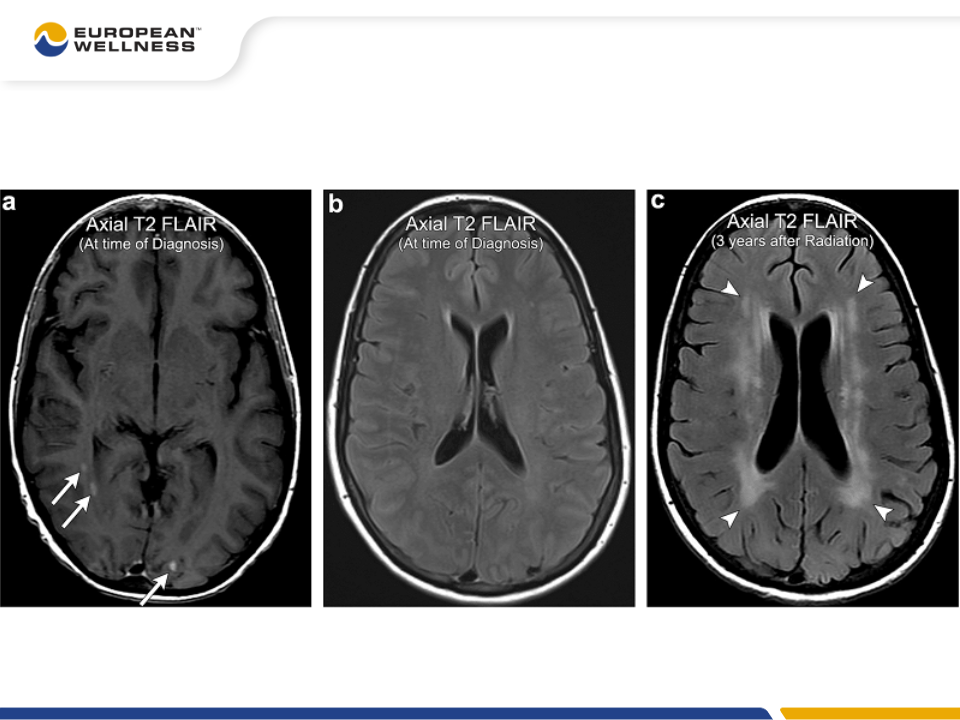 Kết quả chụp MRI của một trường hợp thoái hóa chất trắng