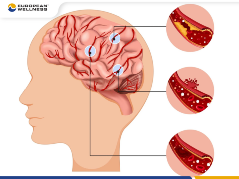 Tai biến mạch máu não là tình huống cực kỳ nguy hiểm