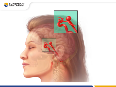 Vỡ phình mạch não là gì?