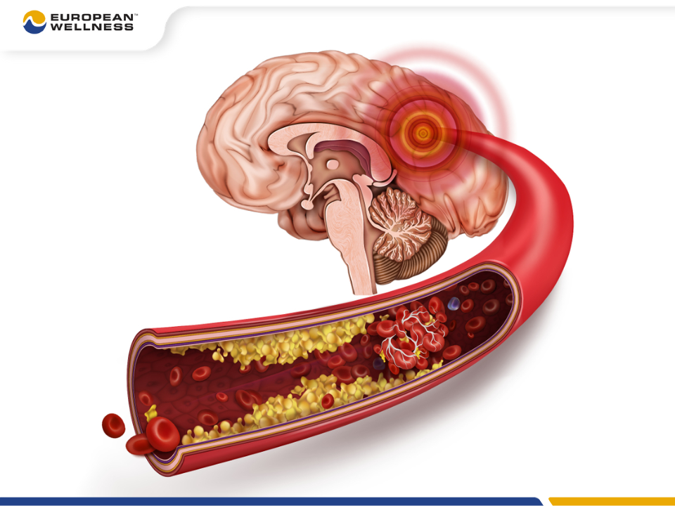 Xơ vữa mạch máu não là tác nhân cực kỳ nguy hiểm