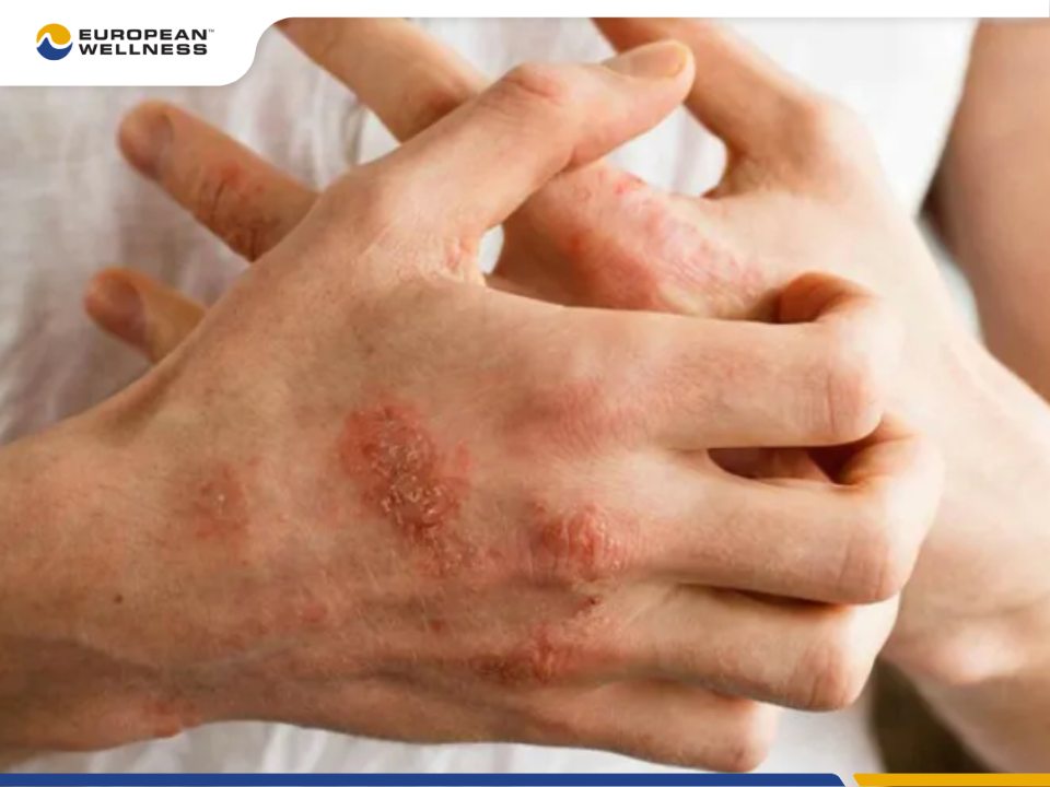 Các loại virus có thể kích thích hệ miễn dịch phản ứng quá mức